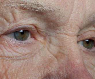 Dementia causes changes in eyesight that can affect behavior
