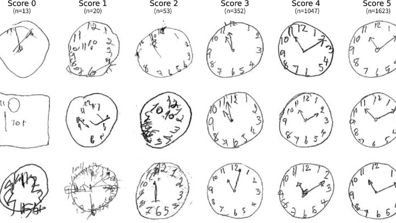 The clock drawing test for dementia is a standard test to diagnose the severity of disease in the early stages.